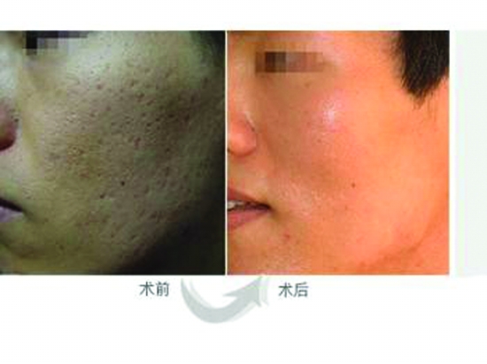 激光去痘坑+还你亮白美肌